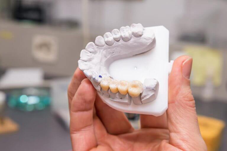 Zahnbrücke - Zahnmodell mit einer Zahnbrücke